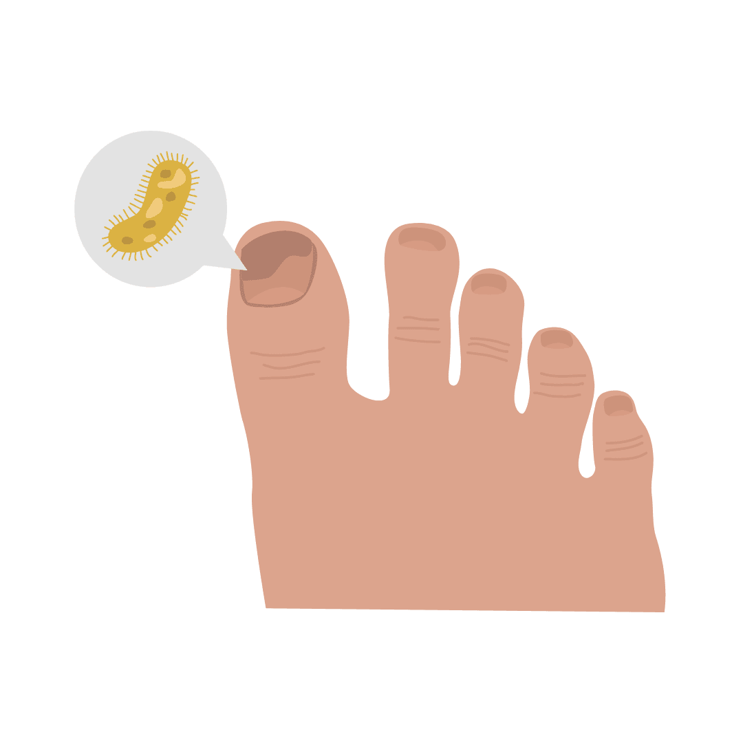 Grzybica paznokci (grzybica paznokci) i grzybica stóp (grzybica stóp)