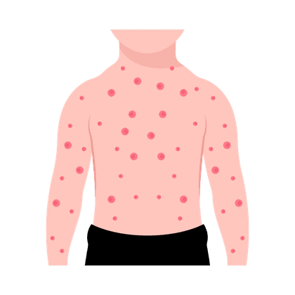 Ospa wietrzna (varicella)